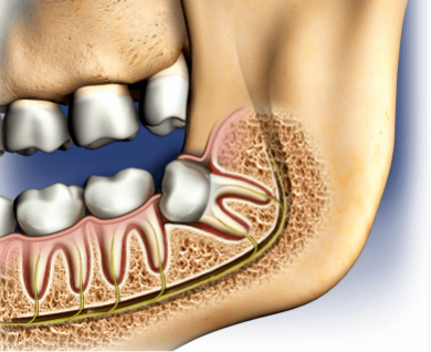 Diagram of a jaw & molars, also showing a wisdom tooth emerging