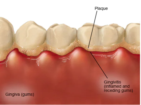 Teeth & gum diagram explaining gingivitis symptoms