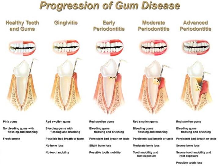 Infographic explaining the step-by-step progression of gum disease