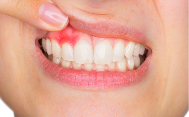 Person raising lip to reveal inflamed gum due to gum disease