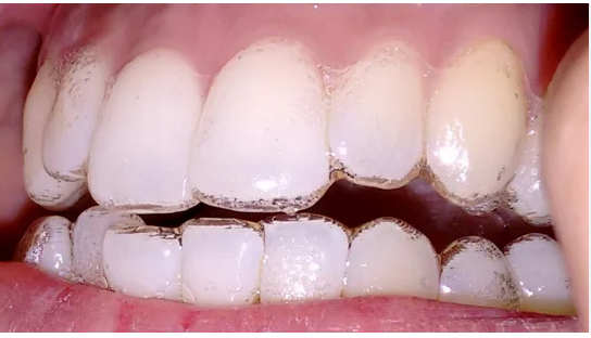 Image showing air gaps present in an invisalign aligner