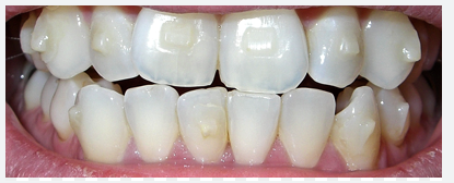 Image showing different attachments in an invisalign aligner