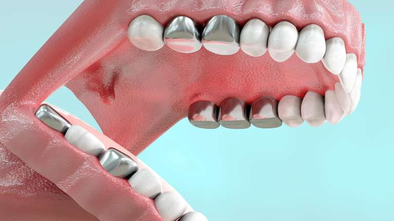 Model of a mouth containing amalgam fillings