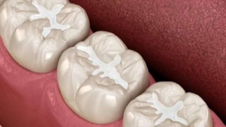 Fissure Sealant Before & After Image | Paddington Dentistry