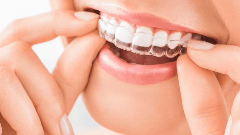 Month of Smile | Woman smiling and wearing Invisalign braces | Paddington Dentistry