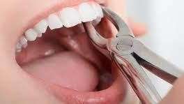 Image depicting a tooth extraction procedure