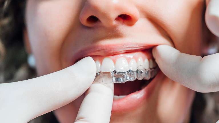 Dentist inserting Invisalign aligners on woman's teeth