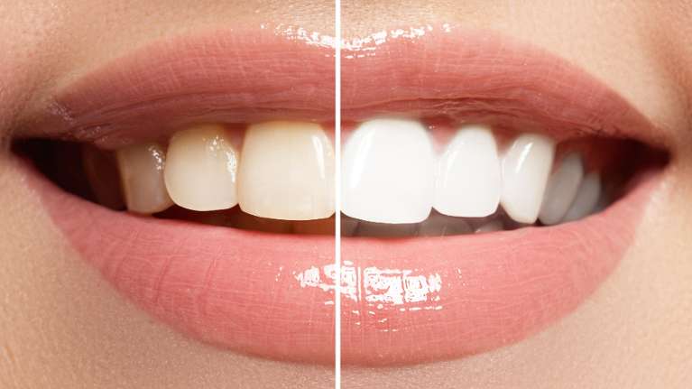 Teeth Whitening Before and After 