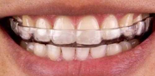 OCCLUSAL-SPLINT-INSTRUCTIONS-banner