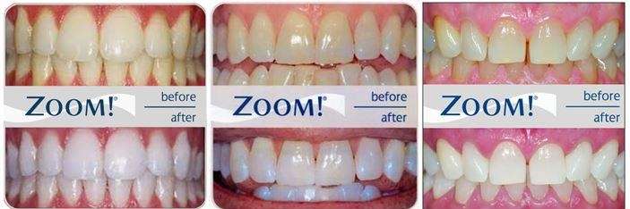 TEETH-WHITENING-AFTER-CARE-banner