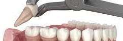 TOOTH-EXTRACTION-AFTER-CARE