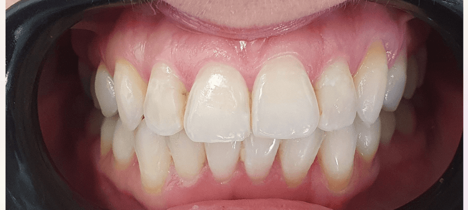 teeth straightening invisalign after