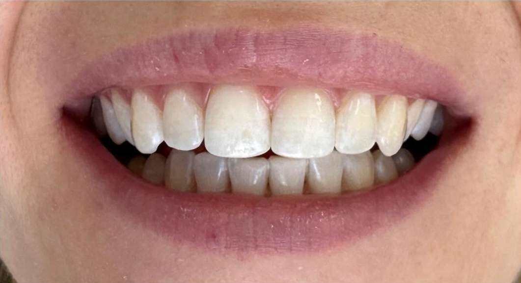 Yellow teeth treatment: after image
