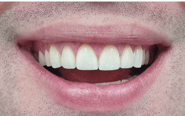 Composite dental veneers before and after: after image