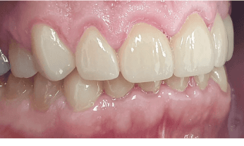 Full mouth reconstruction with dental crowns: after image