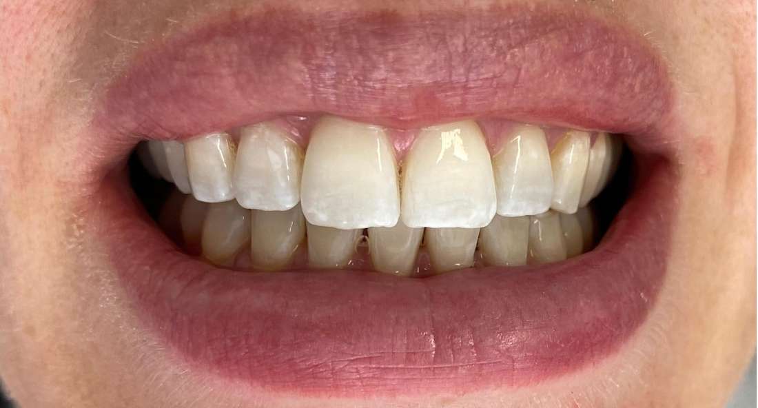 In chair teeth whitening before and after: after image