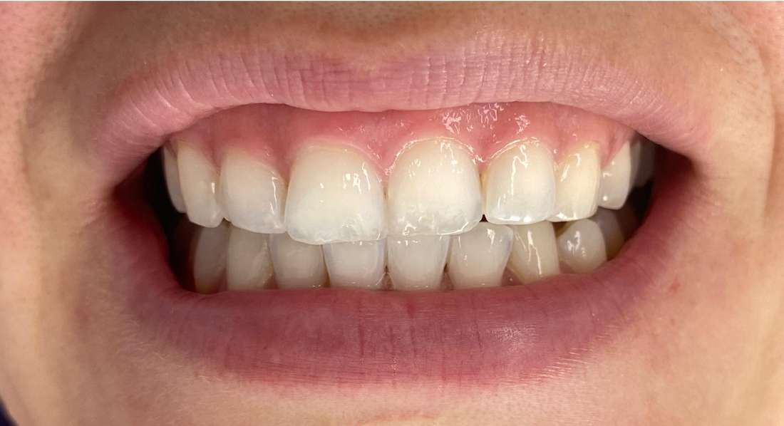 Philips zoom in chair whitening: after treatment