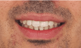 Invisalign Before and After: After Image
