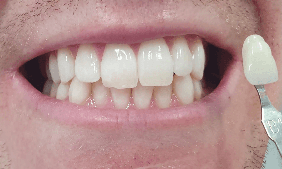 After teeth whitening