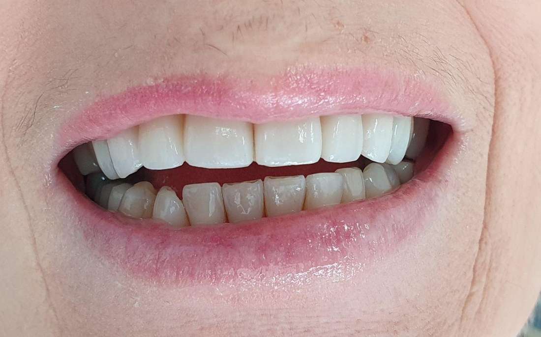 Porcelain veneers before and after: After image