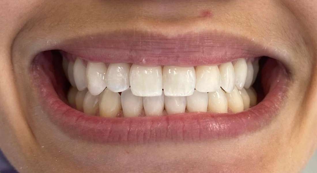 Resin bonding teeth: after image