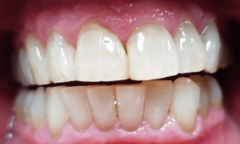 After teeth whitening
