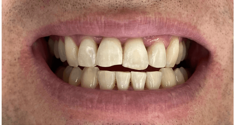 After teeth whitening