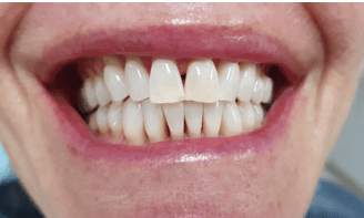 Teeth Whitening Before and After: After Image