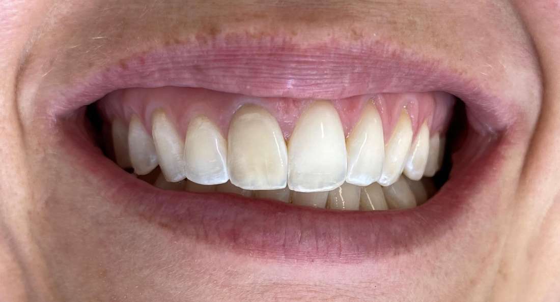 Zoom whitening before and after: after image