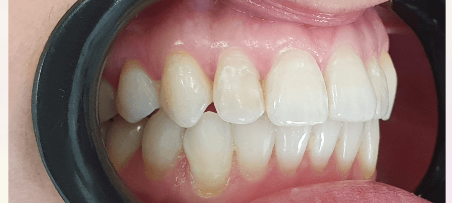 After Invisalign
