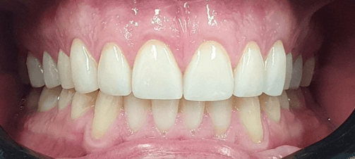 Composite dental veneers before and after: another after image