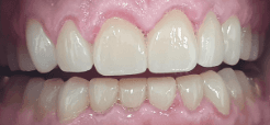 Full mouth reconstruction with dental crowns: close-up after image
