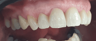 Dental crown procedure: Close-up after image