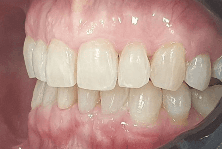 Invisalign treatment: Close-up after image