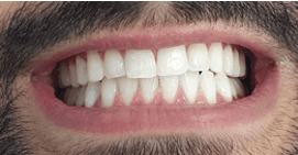 Treatment for whiter smile: after image