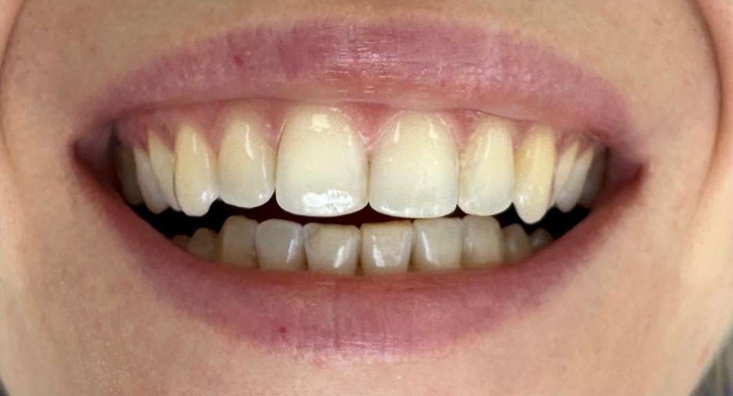 Yellow teeth treatment: before image