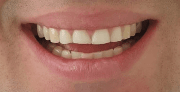 Composite dental veneers before and after: before image