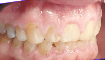 Full mouth reconstruction with dental crowns: before image