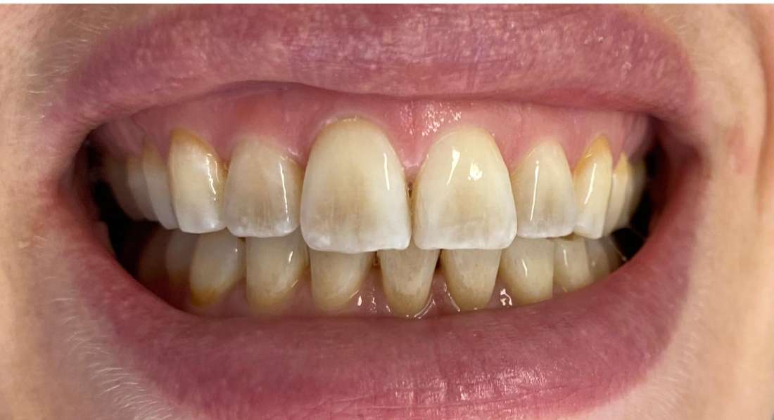 In chair teeth whitening before and after: before image