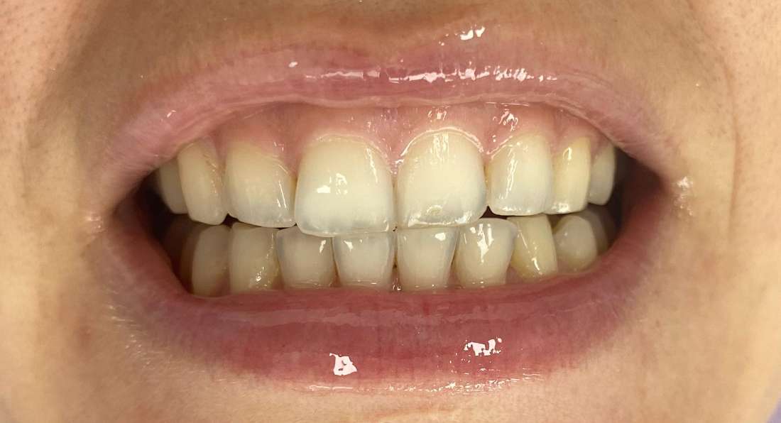 Philips zoom in chair whitening: before treatment