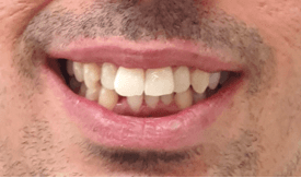 Invisalign Before and After: Before Image