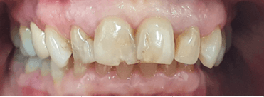 Dental crown procedure: before image