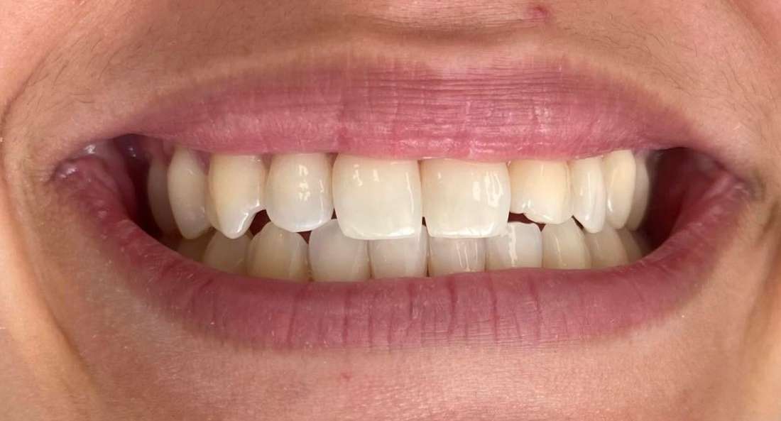 Resin bonding teeth: before image