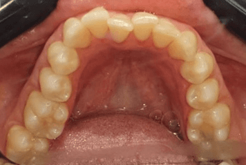 Crowded teeth treatment: before image