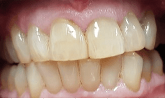 Before teeth whitening