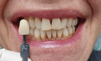 Teeth Whitening Before and After: Before Image