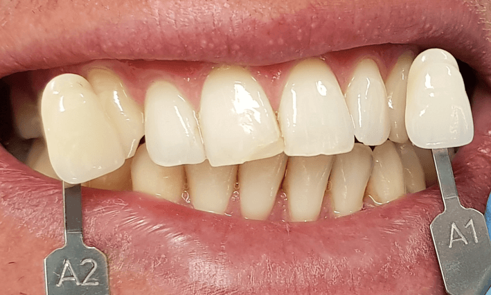 Dentist Teeth Whitening Before and After: Before Image