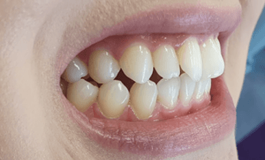 Invisalign treatment for misaligned teeth: Close-up before image
