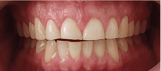 Composite dental veneers before and after: another before image
