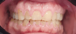 Full mouth reconstruction with dental crowns: close-up before image